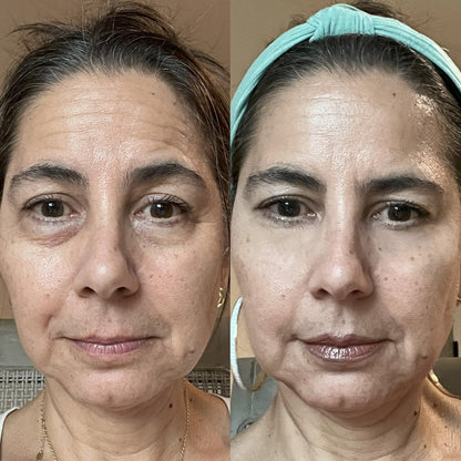 RevitalEyes - Thérapie par Lumière Rouge Pour le Contour des Yeux