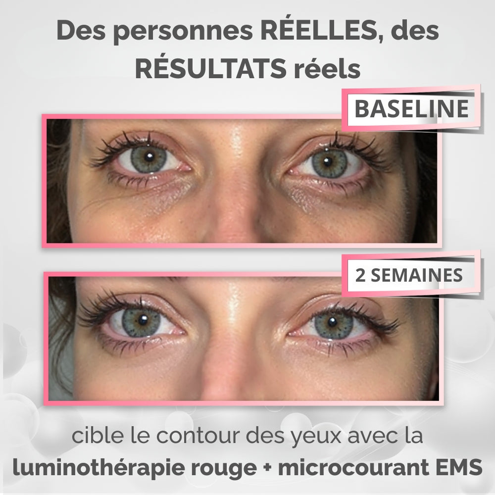 RevitalEyes - Thérapie par Lumière Rouge Pour le Contour des Yeux